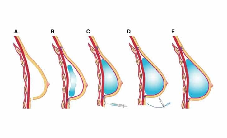 Breast Augmentation Breast Augmentation