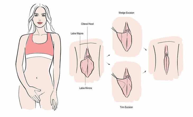 What is Labiaplasty Genital Rejuvenation