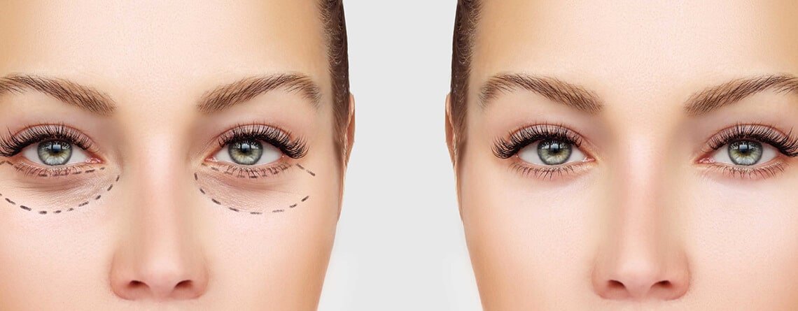 Blepharoplasty Surgery Procedure Blepharoplasty Surgery Procedure