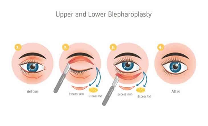 Blepharoplasty Surgery Procedure Blepharoplasty Surgery Procedure