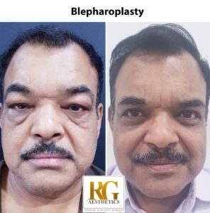 blepharoplasty