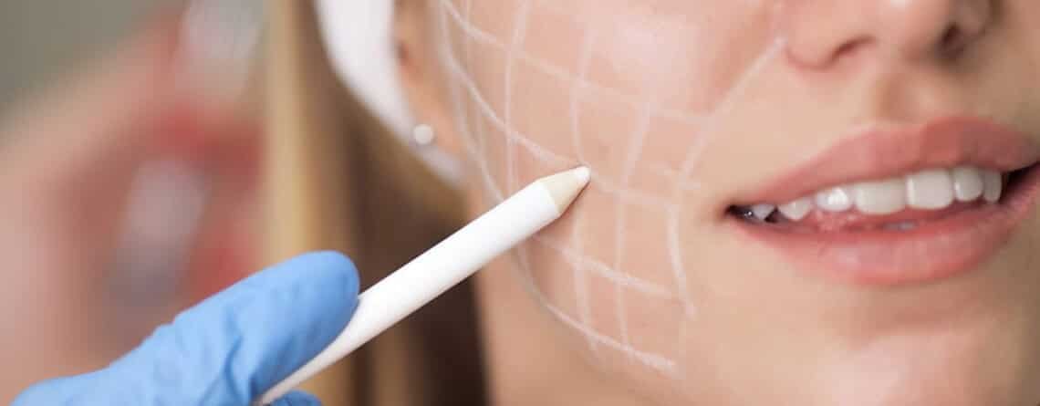 Buccal Pad Fat Removal Procedure Buccal Pad Fat Removal Procedure