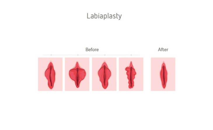 Vaginal Tightening Procedure Vaginal Tightening Procedure