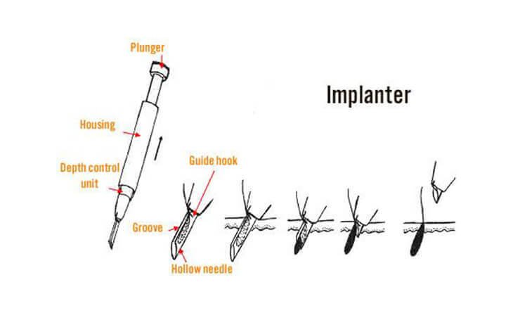 Hair transplant procedure Hair transplant procedure