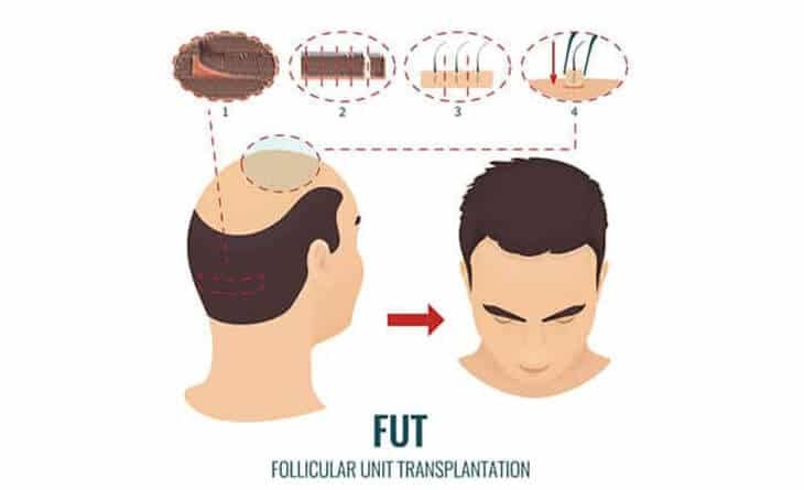 Hair transplant procedure Hair transplant procedure
