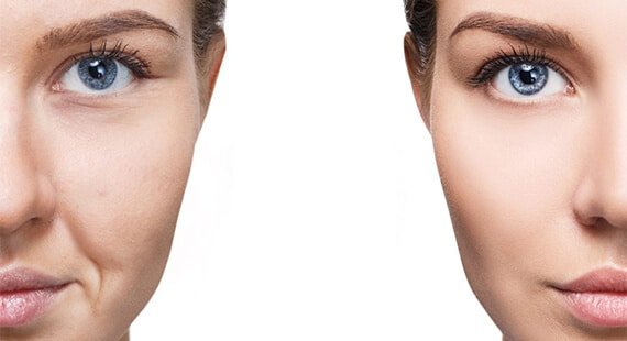 Facial Fat Grafting Facial Fat Grafting