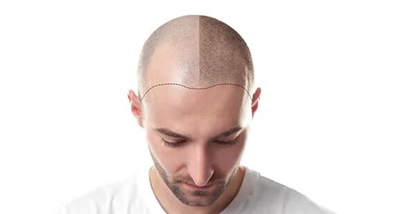 Hair Transplant in Delhi Hair Transplant in Delhi