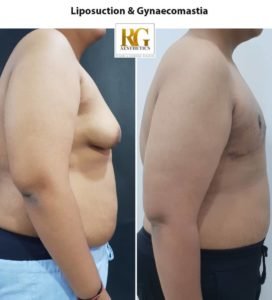 Liposuction surgery