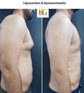 Liposuction surgery