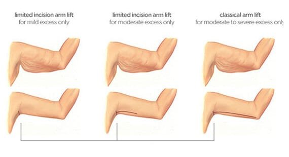 Arm Lift Surgery in Delhi Arm Lift Surgery in Delhi