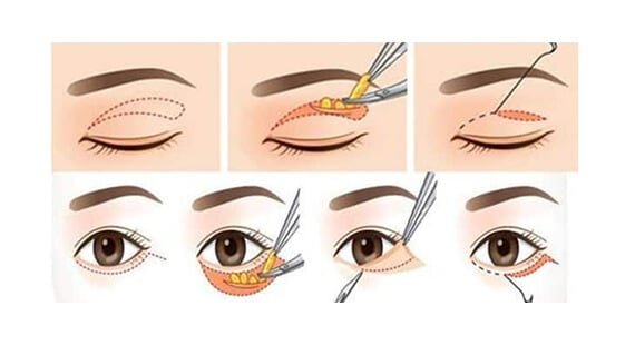 Asian Blepharoplasty in Delhi Asian Blepharoplasty in Delhi