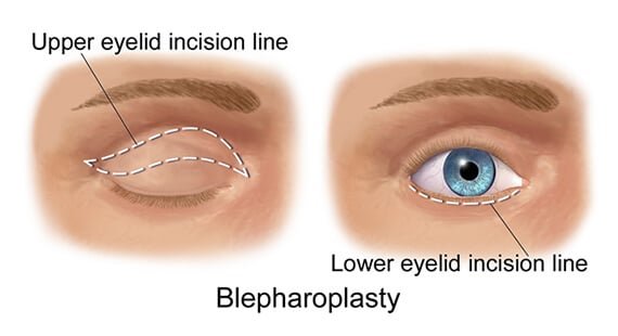 Blepharoplasty eyelid surgery delhi Blepharoplasty eyelid surgery delhi