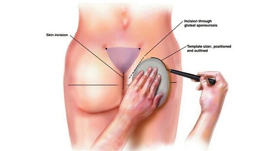 Buttock Augmentation in Delhi Buttock Augmentation in Delhi