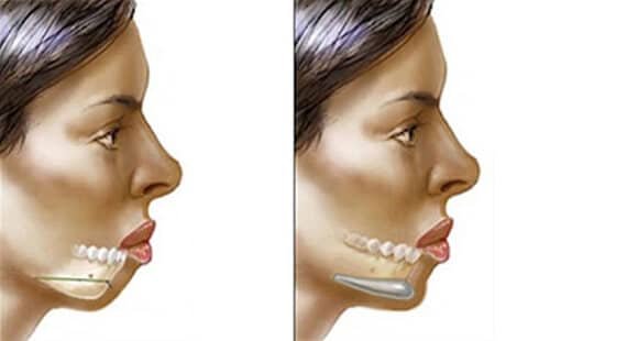 Procedure of Chin Augmentation 033 chin augmentation