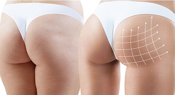 Buttock Augmentation in Delhi Buttock Augmentation in Delhi