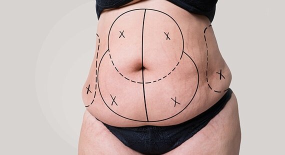 Tummy Tuck Surgery in Delhi, Tummy tuck recovery, Tummy Tuck Surgery cost, Abdominoplasty Surgeon in Delhi, Tummy Tuck surgery before and after, abdominoplasty surgery in Delhi Tummy Tuck Surgery in Delhi, Tummy tuck recovery, Tummy Tuck Surgery cost, Abdominoplasty Surgeon in Delhi, Tummy Tuck surgery before and after, abdominoplasty surgery in Delhi