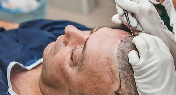 Risk of Hair Transplant - Dr Rajat Gupta Plastic Surgeon 023