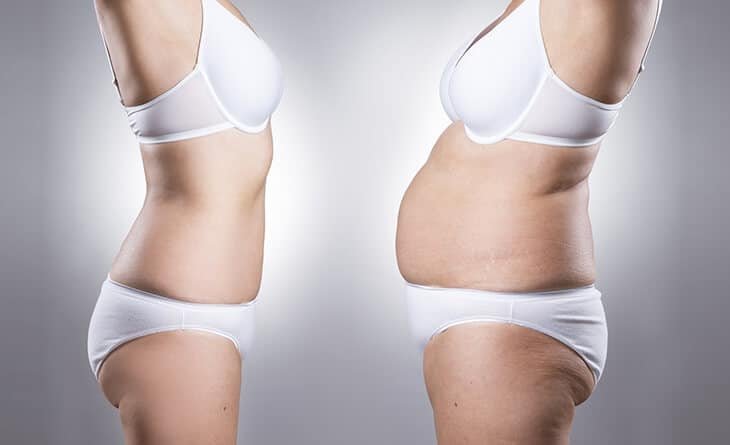 Tummy tuck Procedure