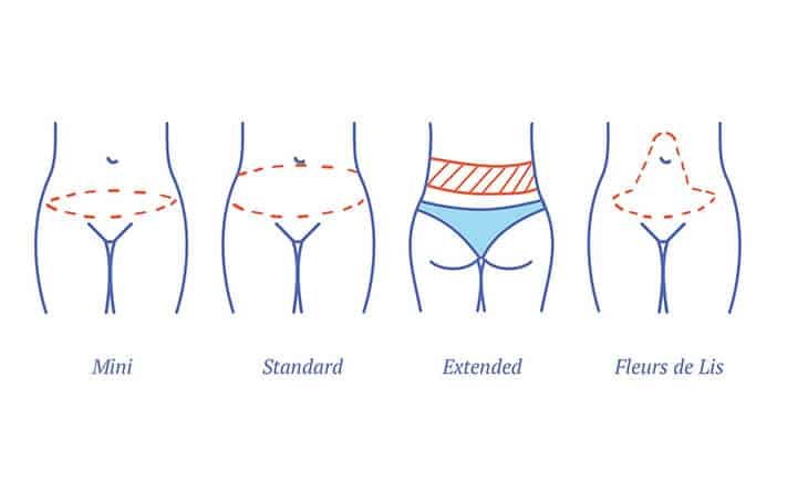 Types of Tummy Tucks - Dr Rajat Gupta