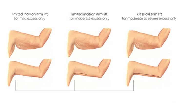 Arm Lift Surgery Procedure Arm Lift Surgery Procedure