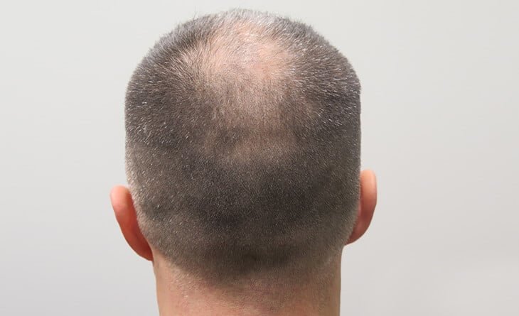 Hair transplant procedure Hair transplant procedure