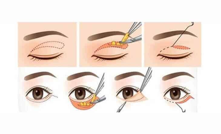 Asian Blepharoplasty Procedure Asian Blepharoplasty Procedure