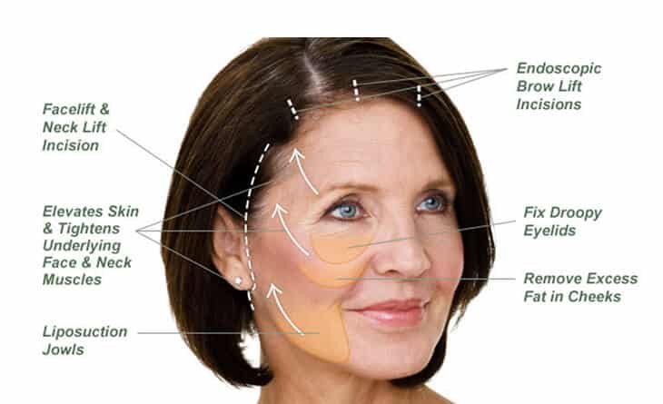 Face Lift Surgery Procedure Face Lift Surgery Procedure