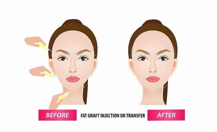 Facial Fat Grafting Procedure Facial Fat Grafting Procedure