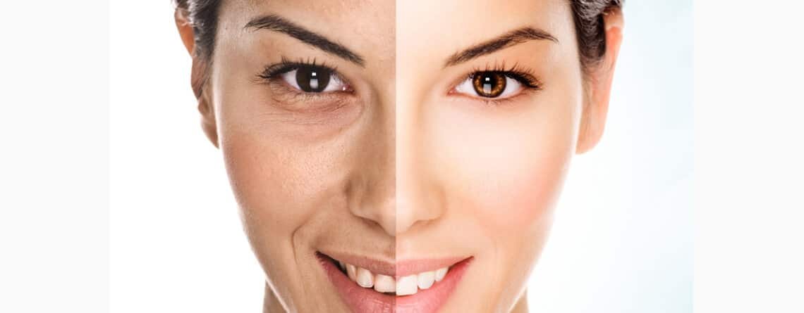 Facial Fat Grafting Procedure Facial Fat Grafting Procedure