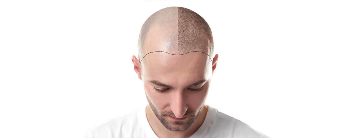 Hair transplant procedure Hair transplant procedure