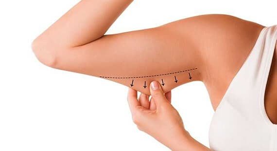 Arm Lift Surgeryin Delhi Arm Lift Surgeryin Delhi