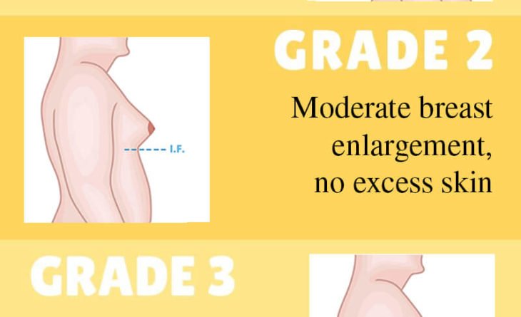 Gynecomastia Grades (1)