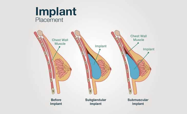 Breast Augmentation Breast Augmentation