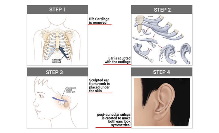 Microtia Microtia