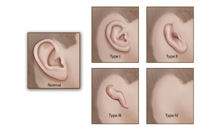 Types of microtia - Dr Rajat Gupta
