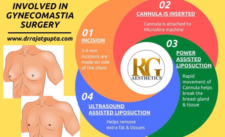 gynecomastia 2 (1)