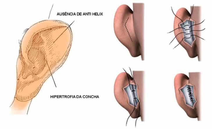 Otoplasty Otoplasty
