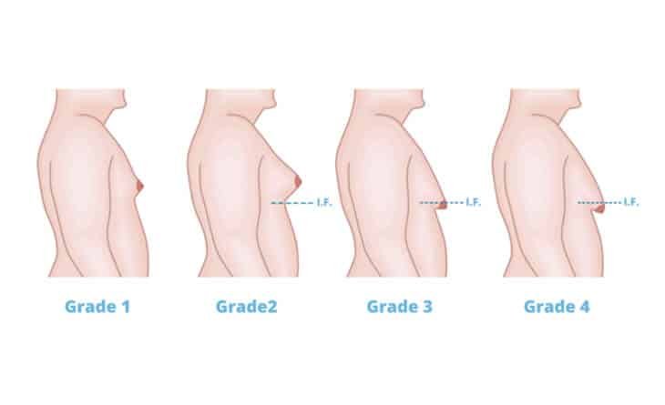 All You Need To Know About Male Breast Reduction - Dr Rajat Gupta - Plastic Surgeon in Delhi - 02 Male breast reduction surgery