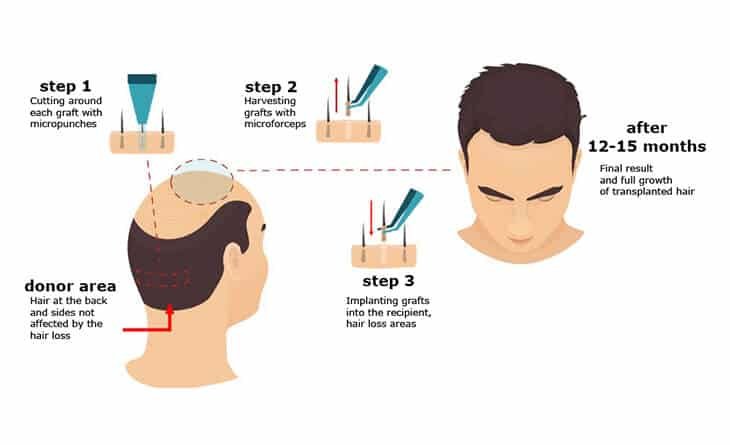 Hair Transplant Surgery Hair Transplant Surgery