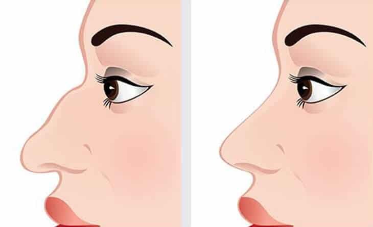 Nose Job - Rhinoplasty Surgery in delhi - Dr Rajat Gupta - Plastic Surgeon in Delhi -033 Nose Job - Rhinoplasty Surgery in delhi - Dr Rajat Gupta - Plastic Surgeon in Delhi -033