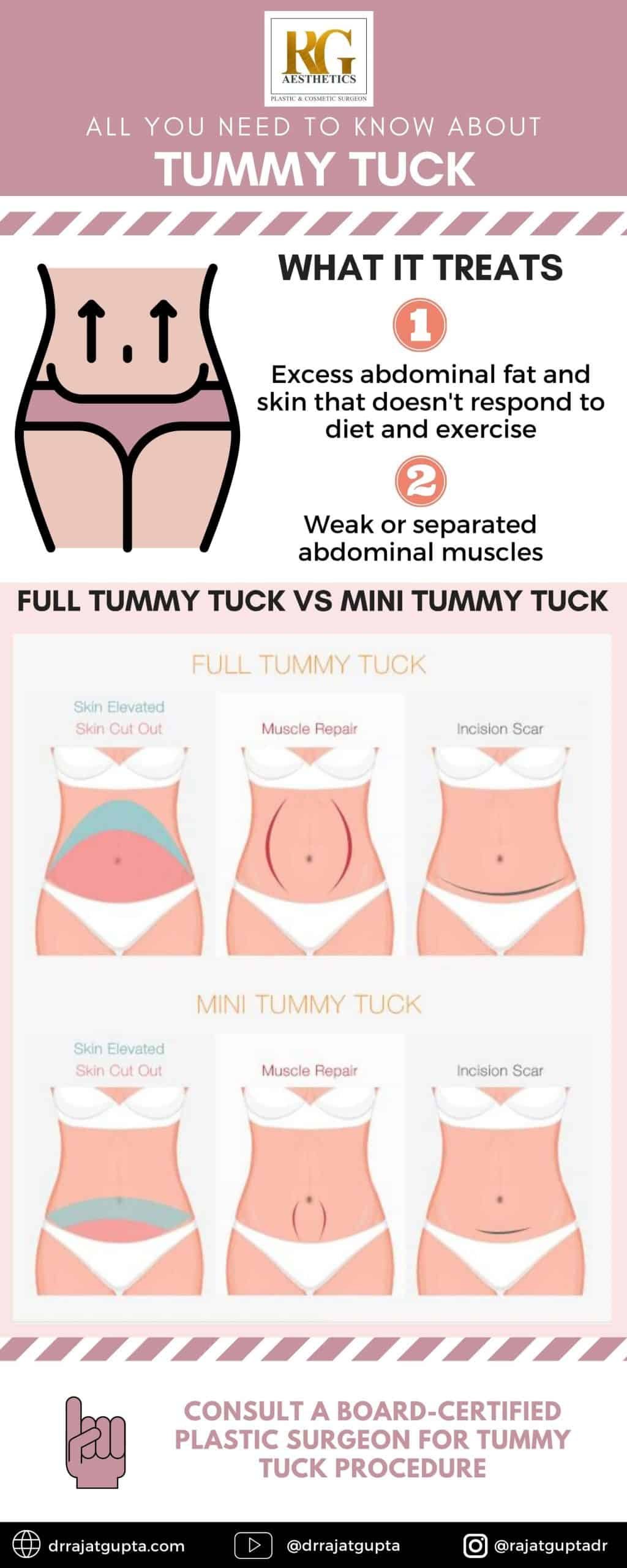 Tummy Tuck - Dr Rajat Gupta -02 (1)