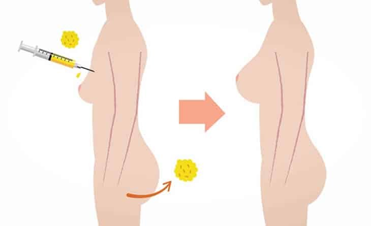 Breast Enhancement Through Fat Grafting - Dr Rajat Gupta breast and buttock augmentation