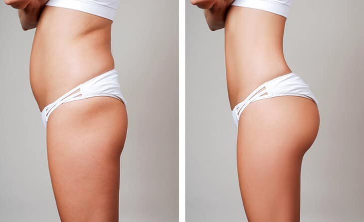 Buttock Augmentation - Dr Rajat Gupta breast and buttock augmentation
