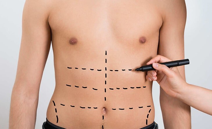 Six Pack Abs Surgery for men - Dr Rajat Gupta Six Packs Surgery for Men