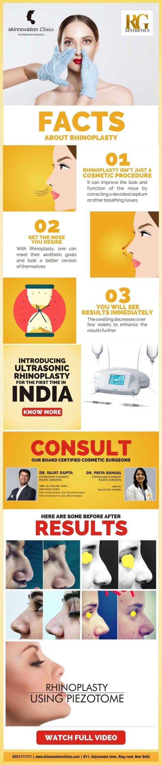 Rhinoplasty - Dr Rajat Gupta - 01