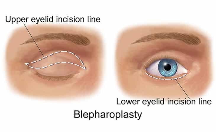 Blepharoplasty Procedure in Delhi- Dr Rajat Gupta (1) Blepharoplasty in Delhi