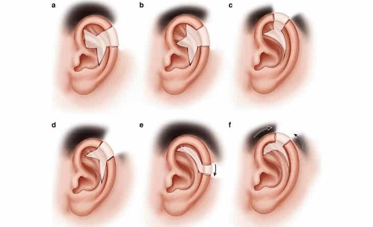 Ear reconstruction surgery - Dr Rajat Gupta - -014 Ear Reconstruction Surgery