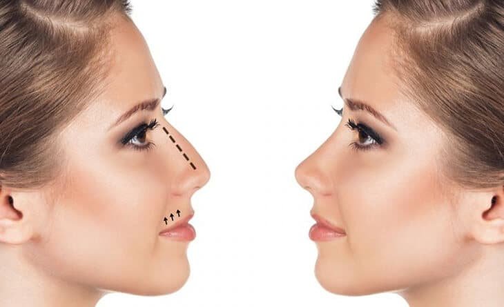 Nose Job or Rhinoplasty - Dr Rajat Gupta - 024 Nose Job or Rhinoplasty
