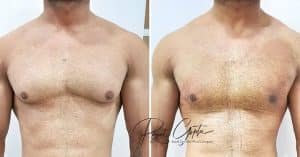 Gynecomastia