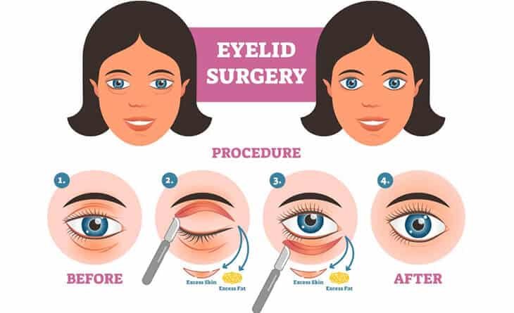 Blepharoplasty Surgery- Dr Rajat Gupta - Plastic Surgeon -02 (1) Blepharoplasty Surgery in Delhi